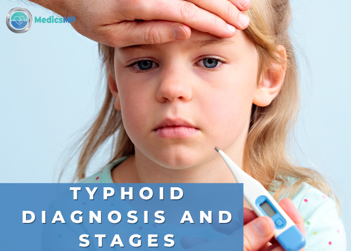 Typhoid Test: Everything to Know About Diagnosis and Stages
